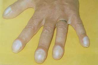 Симптом бронхоэктатической болезни: измененная форма пальцев