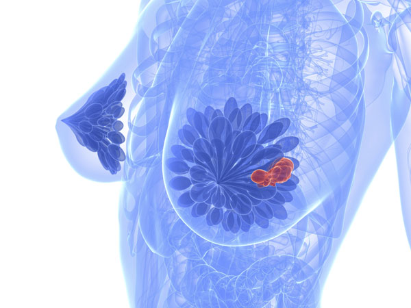 Рак молочной железы у женщин
