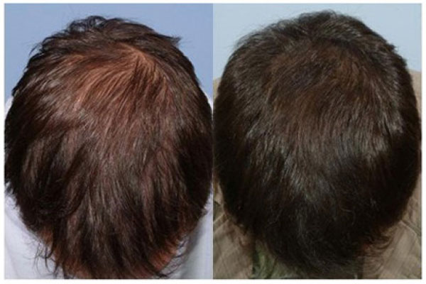 мужские волосы - до и после лечения