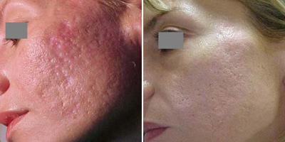Лазерная шлифовка кожи: описание процедуры