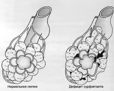 Респираторный дистресс-синдром