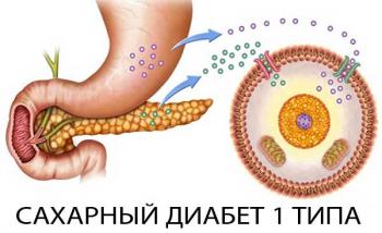 Сахарный диабет 1 типа