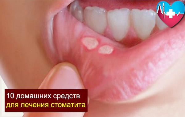 Чем лечить стоматит в домашних условиях Чем лечить стоматит в домашних условиях