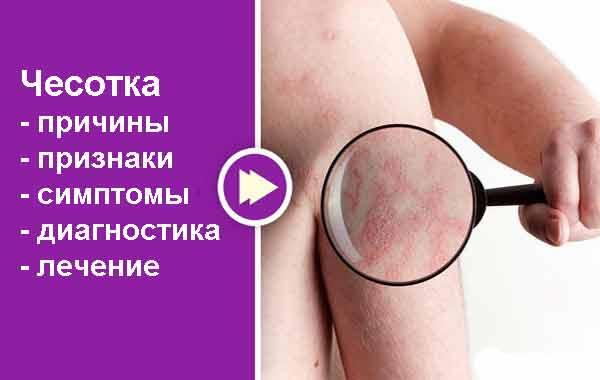 Чесотка, подробно про забоелевание Чесотка, подробно про забоелевание
