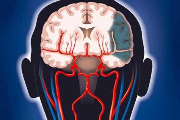Методы лечения ишемического инсульта Методы лечения ишемического инсульта