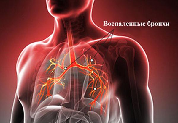Профилактика и лечение бронхита Профилактика и лечение бронхита