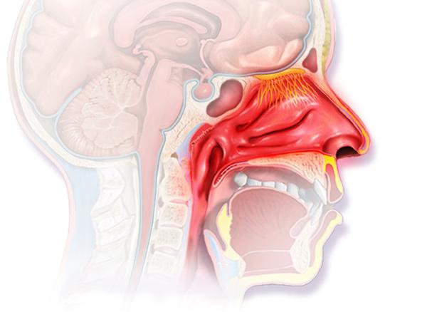 Ринорея: симптомы, причины, лечение