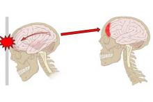 Симптомы и признаки сотрясения