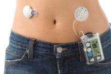 Искусственная поджелудочная железа Medtronic MiniMed получила официальное одобрение FDA Искусственная поджелудочная железа Medtronic MiniMed получила официальное одобрение FDA