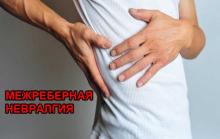 Межреберная невралгия Межреберная невралгия