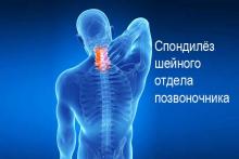 Шейный спондилёз. Симптомы, причины, лечение Шейный спондилёз. Симптомы, причины, лечение