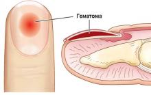 Гематома под ногтем