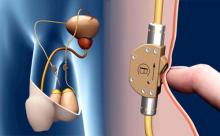 Переключатель семяизвержения - революционный имплантат