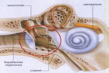 Перфорация барабанной перепонки