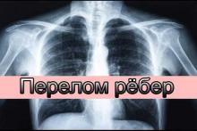 Что делать после перелома рёбер Что делать после перелома рёбер