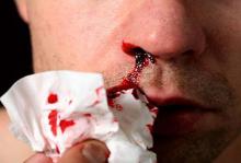Кровь из носа: когда идти к врачу